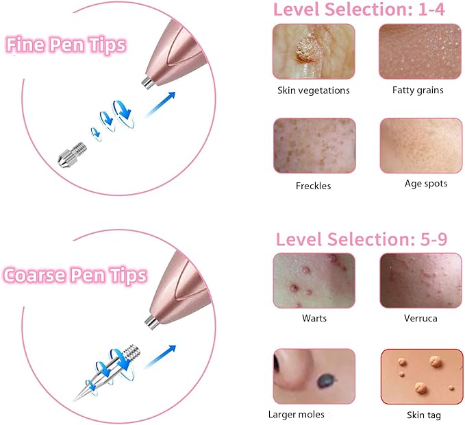 Plasma Pen / Skin Tag Removal